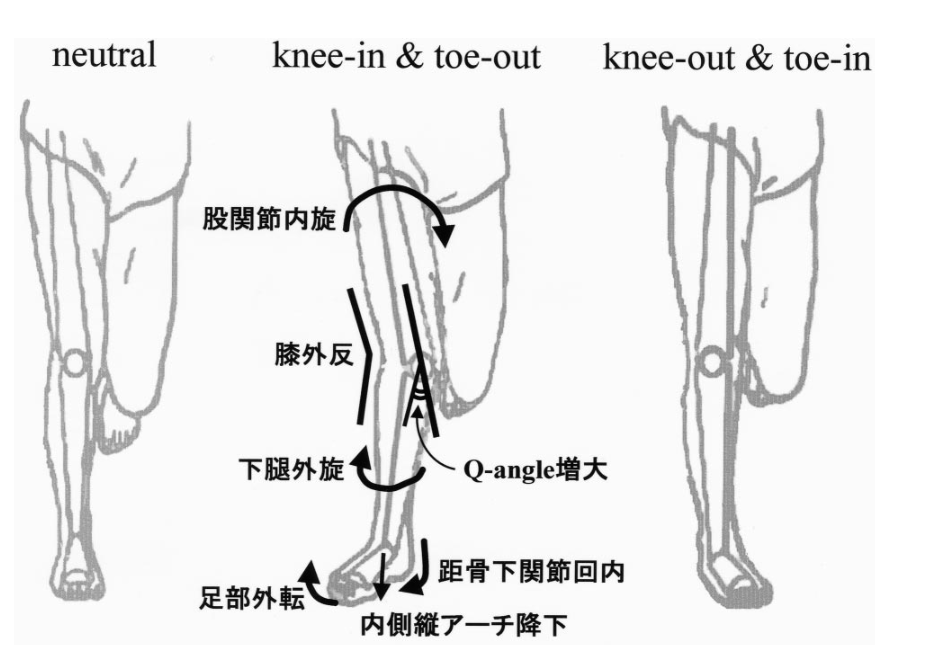 股関節 ひざ連動症候群 下肢リンク症候群