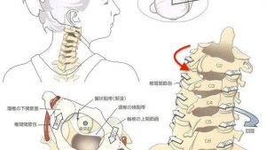 頚椎の回旋障害（左に向けない）