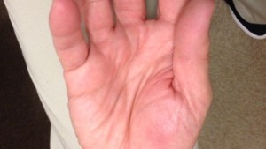 ドケルバン病による手・腕の痛み　症例報告